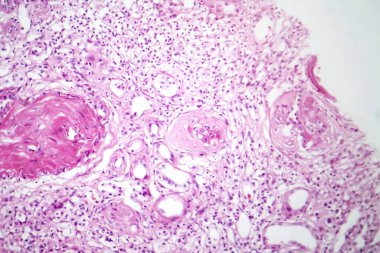 Küçülmüş böbrek dokusu ve anormal nefron yapılarını gösteren birincil parçacık kasılmış böbrek fotomikrografı..