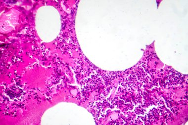 Kanamalı ödem döneminde lobar zatürreenin fotomikrografı akciğer dokusunda kanamalı değişimler gösteriyor..