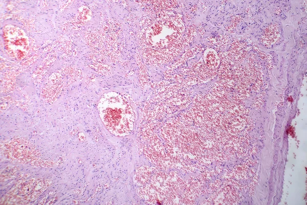 Fotomicrografia Hemangioma Capilar Ilustrando Proliferação Anormal Capilares Característica Tumor Vascular — Fotografia de Stock