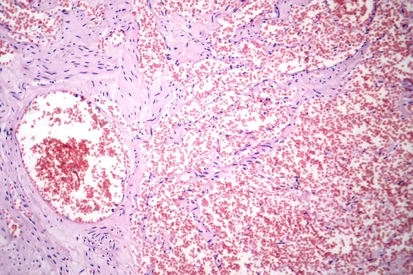 毛細血管血管腫瘍の特徴である毛細血管の異常な増殖を示す毛細血管の写真撮影 — ストック写真