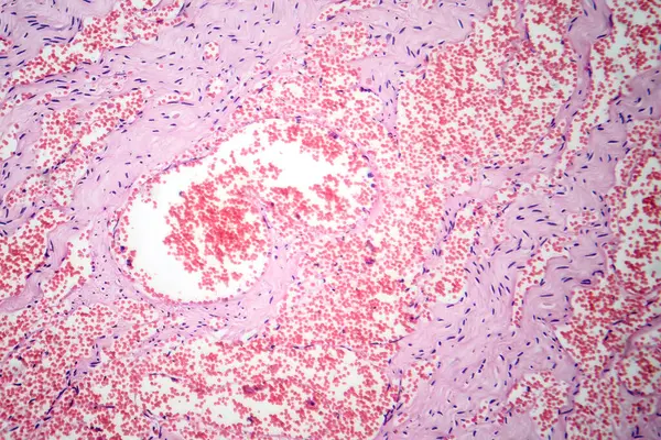 모세관 혈관종의 특징인 모세관의 비정상적인 확산을 보여주는 모세관 혈관종의 포토그래프 — 스톡 사진
