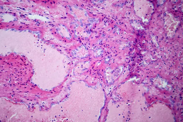 Photomicrograph of hepatic cavernous hemangioma, depicting dilated blood vessels in the liver tissue, characteristic of a benign tumor.