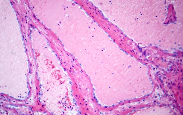 Photomicrograph of hepatic cavernous hemangioma, depicting dilated blood vessels in the liver tissue, characteristic of a benign tumor.