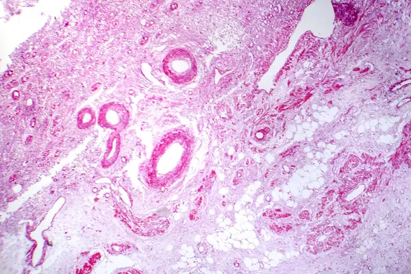 原发性颗粒收缩肾的显微照片 显示肾组织萎缩和肾结构异常 — 图库照片