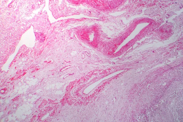 原发性颗粒收缩肾的显微照片 显示肾组织萎缩和肾结构异常 — 图库照片