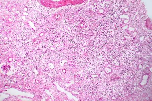 Photomicrograph Primary Particulate Contracted Kidney Illustrating Shrunken Renal Tissue Abnormal — Stock Photo, Image