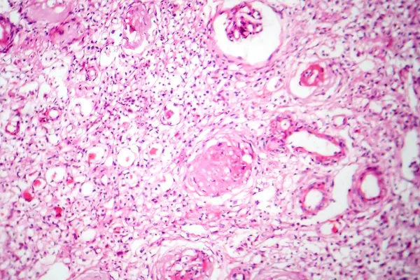 Photomicrograph Primary Particulate Contracted Kidney Illustrating Shrunken Renal Tissue Abnormal — Stock Photo, Image