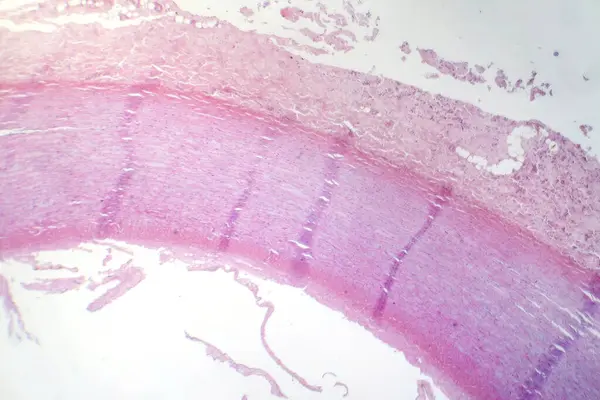 Photomicrograph of fibrinoid necrosis in a vessel wall, displaying damaged vessel integrity and immune response-related changes.