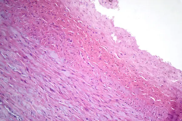 Photomicrograph of fibrinoid necrosis in a vessel wall, displaying damaged vessel integrity and immune response-related changes.