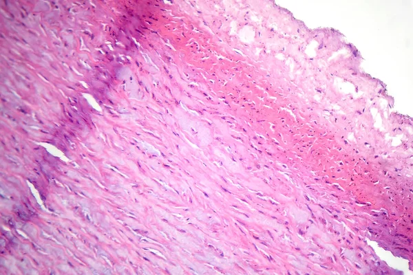 血管壁纤维蛋白样坏死的显微照片 显示受损的血管完整性及与免疫应答有关的变化 — 图库照片