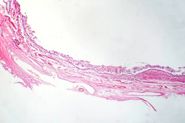 Fotomicrogramma Bronchite Cronica Mostrando Fodera Bronchiale Infiammata Con Produzione Muco — Foto Stock