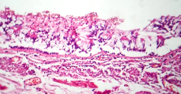 Fotomikrográf Krónikus Bronchitis Mutatja Gyulladt Hörgőbél Túlzott Nyálka Termelés Jellemző — Stock Fotó