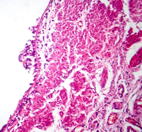 Fotomicrogramma Bronchite Cronica Mostrando Fodera Bronchiale Infiammata Con Produzione Muco — Foto Stock