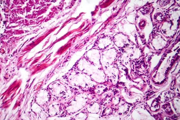 Photomicrograph of chronic bronchitis, showing inflamed bronchial lining with excess mucus production, characteristic of airway disease.
