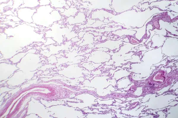 Фотомикрограф Диффузной Эмфиземы Выявляющий Поврежденные Ткани Легких Увеличенными Воздушными Пространствами — стоковое фото