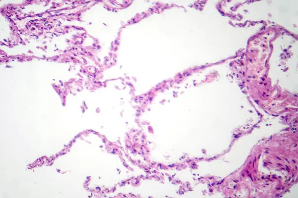 Photomicrograph Diffuse Emphysema Revealing Damaged Lung Tissue Enlarged Airspaces Characteristic — Stock Photo, Image