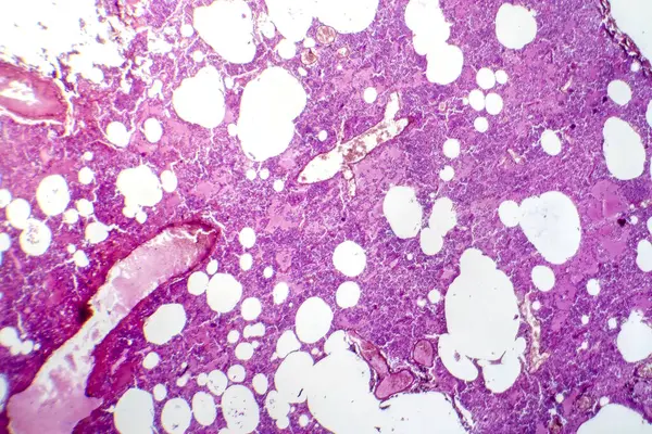 Fotomicrograaf Van Lobale Pneumonie Tijdens Hemorragische Oedeem Periode Vertonen Longweefsel — Stockfoto