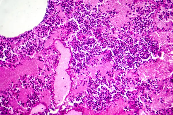 Photomicrographie Pneumonie Lobaire Pendant Période Œdème Hémorragique Montrant Une Inflammation — Photo