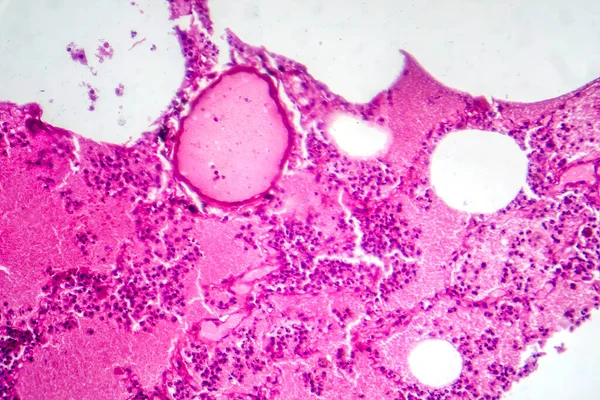 出血性水肿期小叶性肺炎影像学表现为肺组织炎症及出血性变化 — 图库照片