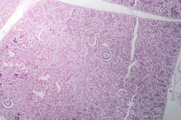 Fotomicrografia Pneumonia Lobar Fase Hepática Vermelha Exibindo Tecido Pulmonar Inflamado — Fotografia de Stock