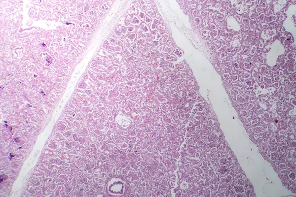 Photomicrograph of lobar pneumonia in red hepatic phase, displaying inflamed lung tissue with red hepatization characteristic of the disease.