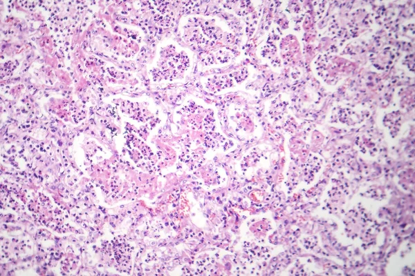 Photomicrograph Lobar Pneumonia Red Hepatic Phase Displaying Inflamed Lung Tissue — Stock Photo, Image