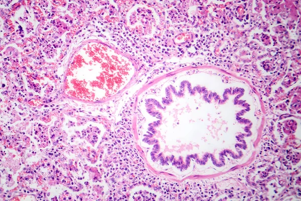 Fotomicrografía Neumonía Lobar Fase Hepática Roja Mostrando Tejido Pulmonar Inflamado — Foto de Stock