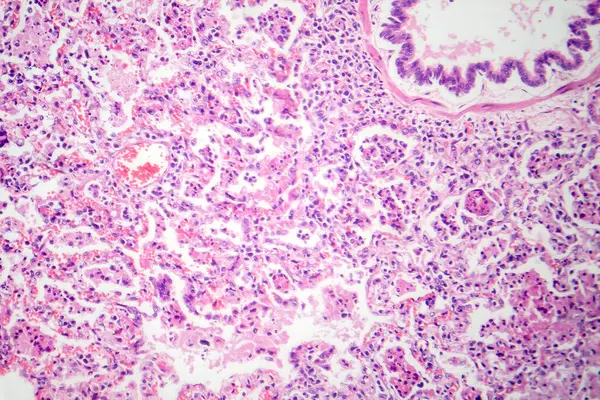 Photomicrograph of lobar pneumonia in red hepatic phase, displaying inflamed lung tissue with red hepatization characteristic of the disease.