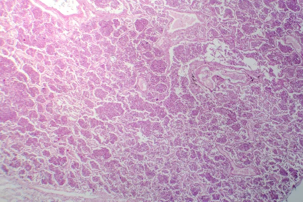 Fotomicrografia Pneumonia Lobar Fase Hepática Cinzenta Revelando Transição Tecido Pulmonar — Fotografia de Stock