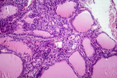 Toksik bir guatr doku örneğinin mikroskop altında fotokopisi tiroid foliküler hücrelerin hipertrofini, artan vasküleriteyi ve koloid tükenmesini gösteriyor..
