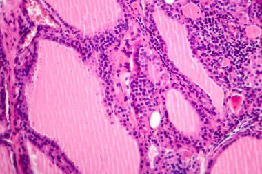 Toksik bir guatr doku örneğinin mikroskop altında fotokopisi tiroid foliküler hücrelerin hipertrofini, artan vasküleriteyi ve koloid tükenmesini gösteriyor..