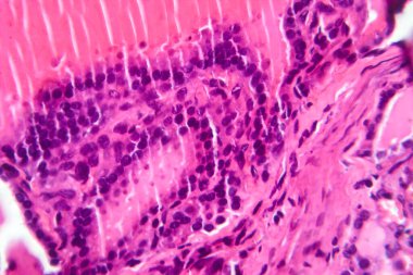 Toksik bir guatr doku örneğinin mikroskop altında fotokopisi tiroid foliküler hücrelerin hipertrofini, artan vasküleriteyi ve koloid tükenmesini gösteriyor..