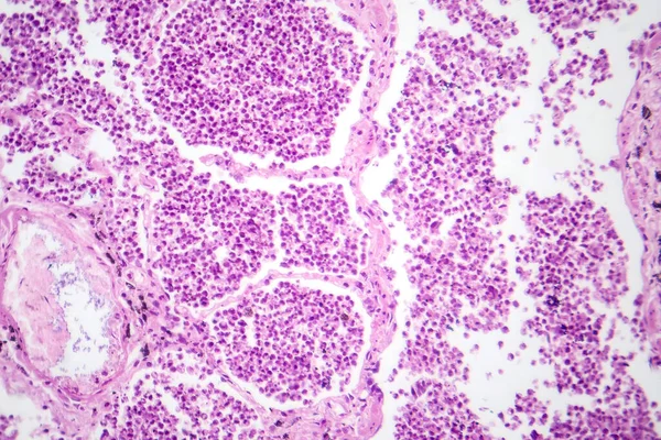 Fotomikrografi Lobar Pneumoni Grå Leverfas Avslöjar Lungvävnadsövergång Med Exudatfylld Alveoli — Stockfoto