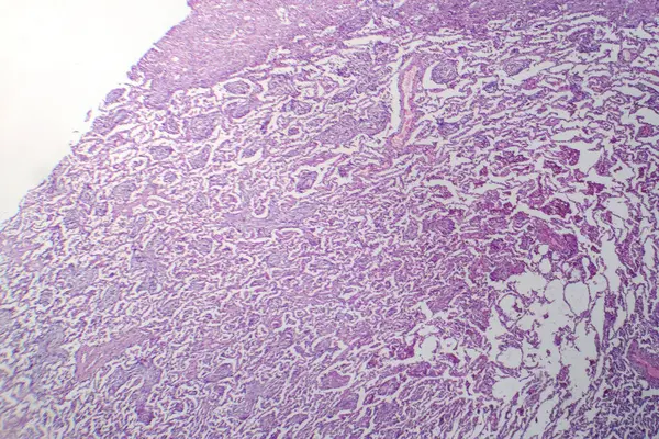 溶解期小叶性肺炎的显微照片 显示消炎及肺组织清除 — 图库照片