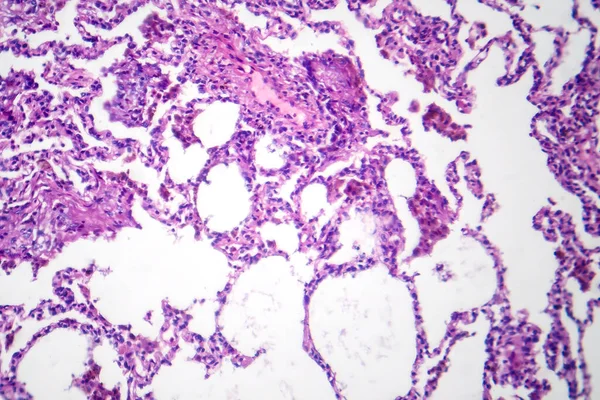 Photomicrograph Lobar Pneumonia Dissolved Dissipate Period Showing Resolving Inflammation Clearing — Stock Photo, Image