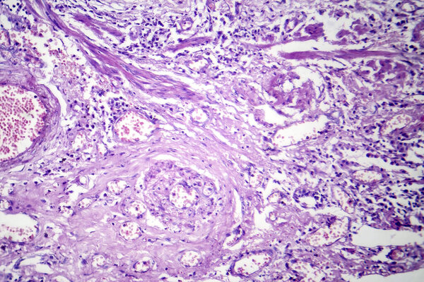 Фотомикрограф вирусной пневмонии, показывающий воспаление и клеточные повреждения, вызванные вирусной респираторной инфекцией.