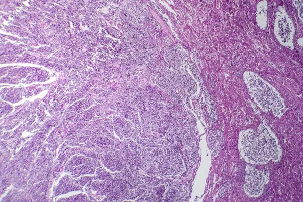 Fotomikrograf Malobuněčného Karcinomu Plic Odhalující Hustě Nabité Maligní Buňky Charakteristické — Stock fotografie