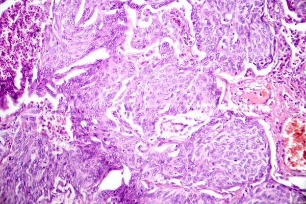 일반적인 유형의 폐암의 특징으로 세포를 보여주는 선암의 그래프 — 스톡 사진
