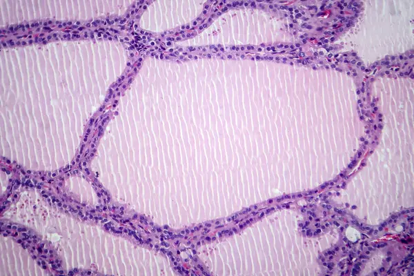 Photomicrograph of an endemic goiter tissue sample under a microscope, revealing thyroid gland abnormalities, including thyroid follicular cell hyperplasia and colloid-filled follicles.