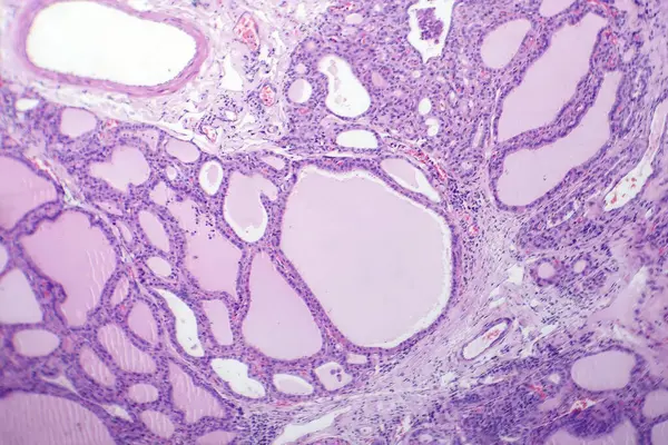 Photomicrograph of an endemic goiter tissue sample under a microscope, revealing thyroid gland abnormalities, including thyroid follicular cell hyperplasia and colloid-filled follicles.