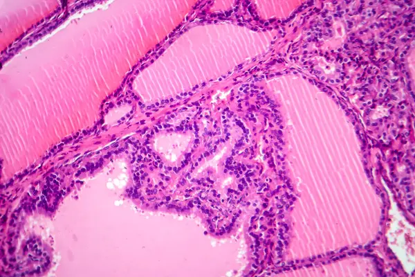 Photomicrograph of a toxic goiter tissue sample under a microscope, revealing hypertrophy of thyroid follicular cells, increased vascularity, and colloid depletion.