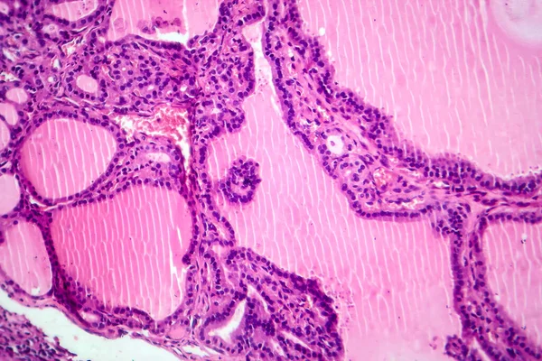 Photomicrograph of a toxic goiter tissue sample under a microscope, revealing hypertrophy of thyroid follicular cells, increased vascularity, and colloid depletion.