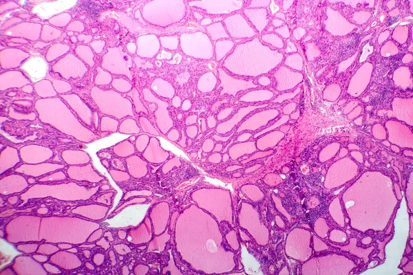 Photomicrograph Toxic Goiter Tissue Sample Microscope Revealing Hypertrophy Thyroid Follicular — Stock Photo, Image