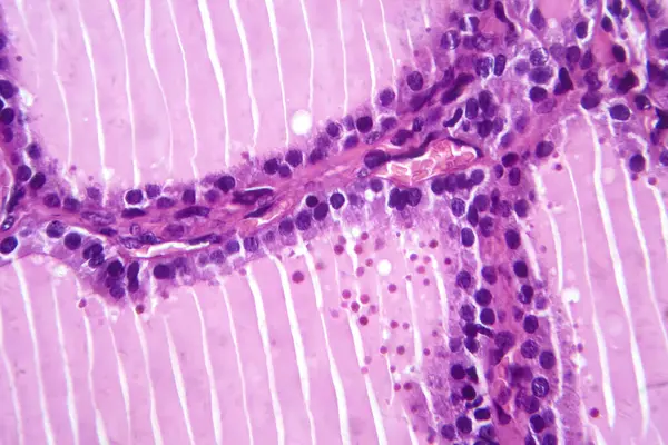 Fotomicrografía Una Muestra Tejido Bocio Tóxico Bajo Microscopio Revelando Hipertrofia —  Fotos de Stock