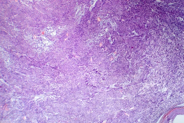Fotomikrográf Leiomyoma Illusztráló Jóindulatú Simaizom Tumorsejtek Méhszövetben — Stock Fotó