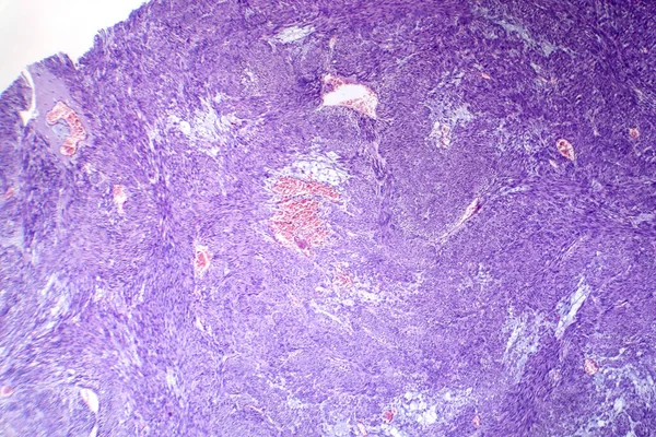 Photomicrograph of leiomyoma, illustrating benign smooth muscle tumor cells within the uterine tissue.