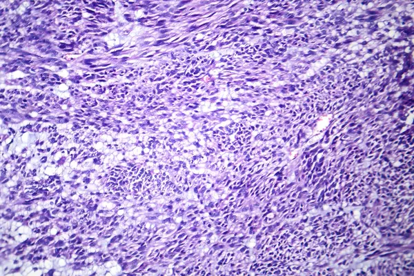 Fotomikrográf Leiomyoma Illusztráló Jóindulatú Simaizom Tumorsejtek Méhszövetben — Stock Fotó