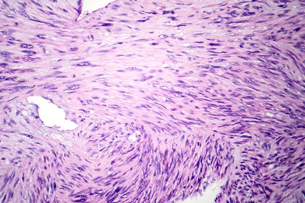 Photomicrograph of leiomyosarcoma, depicting malignant smooth muscle tumor cells, indicative of aggressive soft tissue cancer.