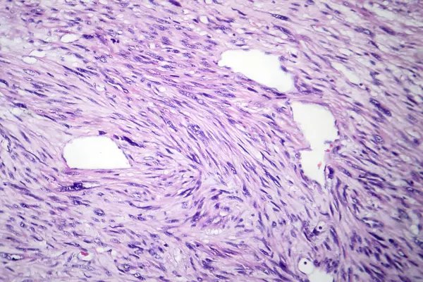 Fotomicrografía Del Leiomiosarcoma Que Representa Células Tumorales Malignas Del Músculo —  Fotos de Stock