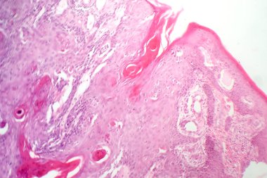 Midede mukoza kanserinin fotomikroskobu, kötü huylu muksin üreten hücreler gösteriyor, agresif mide kanserinin karakteristiği..
